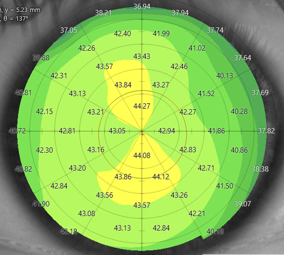 Regular astigmatism