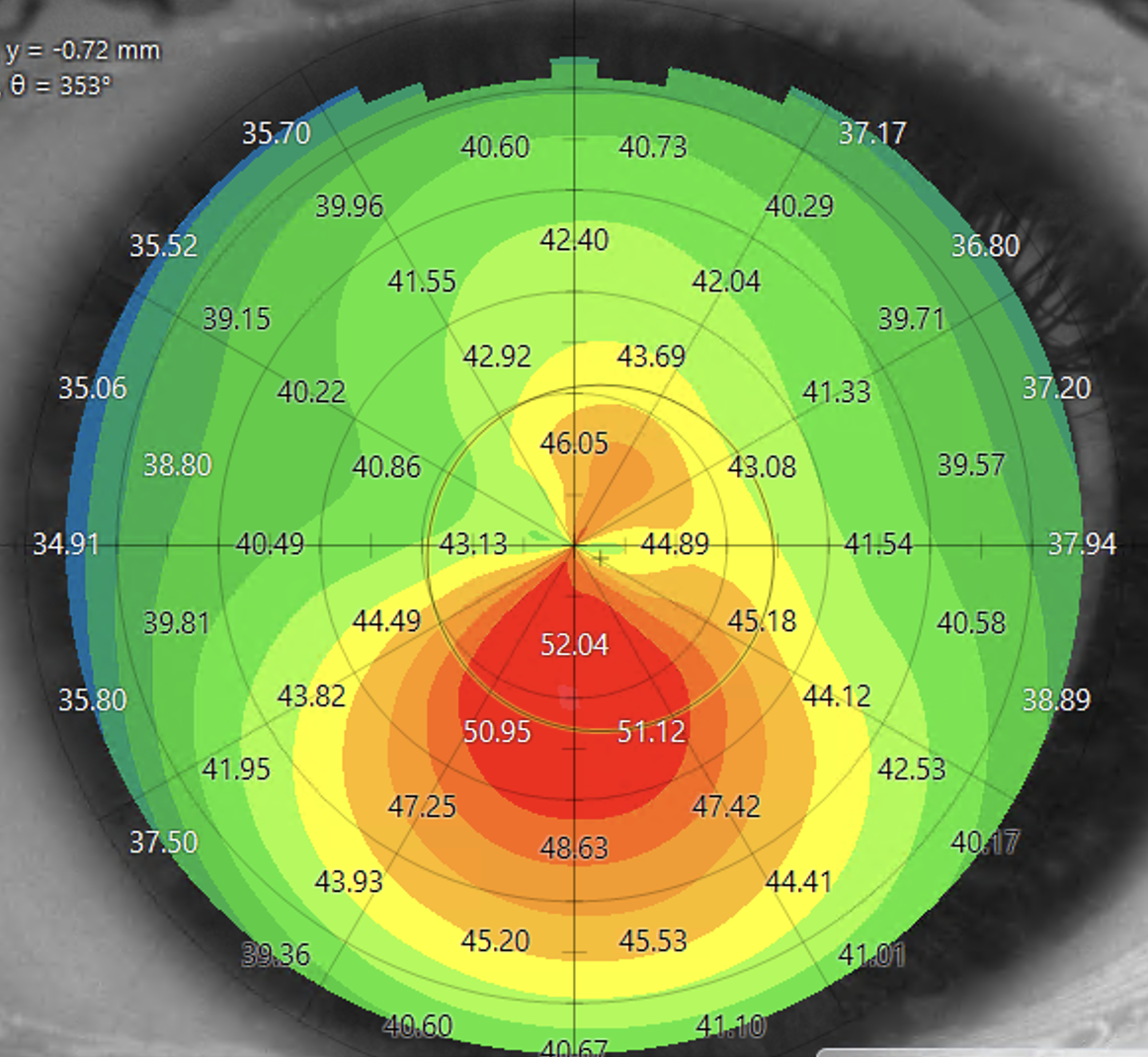 Keratoconus Keratoconus